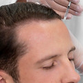 Hair loss treatment for receding hairline in Abu Dhabi