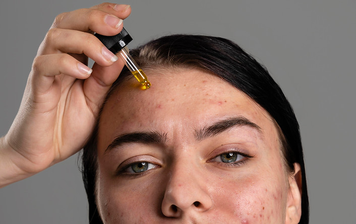 Acne scar treatment at Skin and Slim Medical Center Abu Dhabi using advanced dermatology solutions
