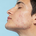 Jawline acne scar treatment in Abu Dhabi to smooth uneven skin caused by acne