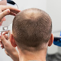 Hair loss treatment for crown area baldness in Abu Dhabi