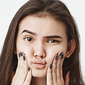 Cheeks area microneedling treatment at Skin and Slim Abu Dhabi