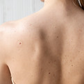 Back acne scar treatment at Skin and Slim Medical Center Abu Dhabi to fade larger scars from breakouts