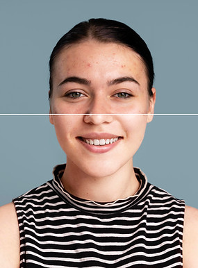 Before and after results of acne scar treatment at Skin and Slim Abu Dhabi showing smoother, clearer skin