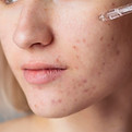 Chin acne scar treatment in Abu Dhabi targeting pitted scars and rough skin texture