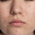 Nose acne scar treatment at Skin and Slim Abu Dhabi for minimizing ice-pick scars