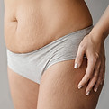 Stretchmarks microneedling treatment at Skin and Slim Abu Dhabi