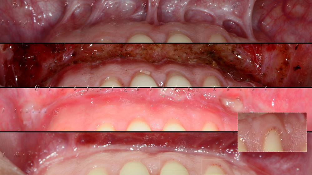 Dr. Pablo García Muñoz, cirugía oral laser, frenillo bucal