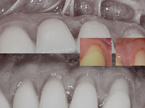 Cirugía oral laser.