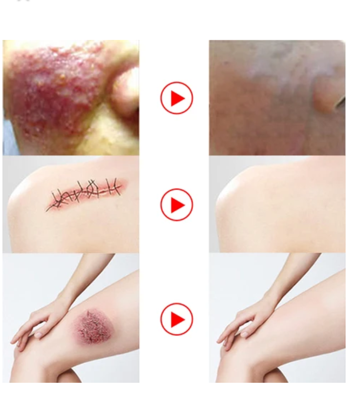 Thumbnail: TCM
SCARAND
ACNE MARK
REMOVAL GEL
OINTMENT