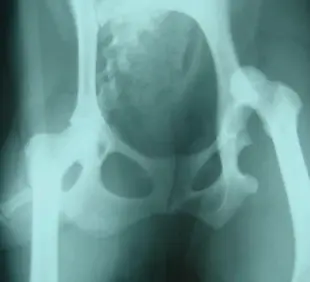 股関節脱臼HP.webp