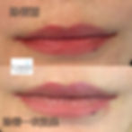 紋唇不均勻改善