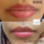 唇內與唇框顏色改善