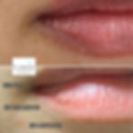 唇外與唇內色澤不均改善