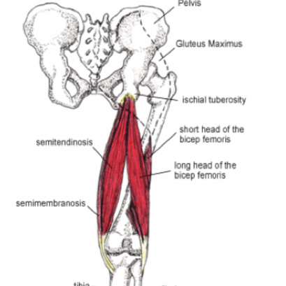 Load, Lengthen, Snap! Hamstring Avulsions