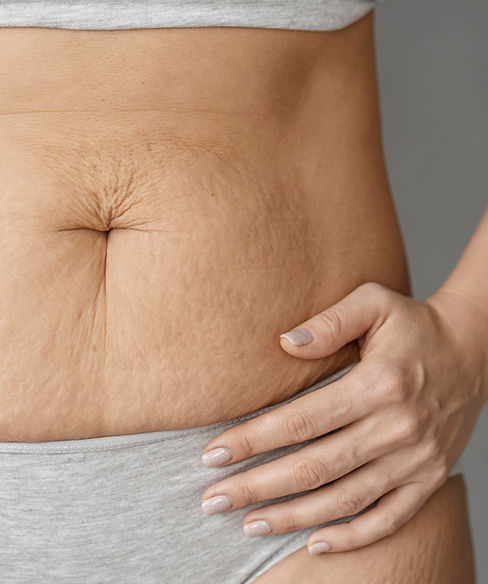 close-up-body-with-stretch-marks.jpg