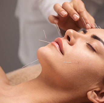 Acupuntura para dores de cabeça e enxaqueca, utilizando agulhas finas em pontos estratégicos do corpo para alívio da dor.