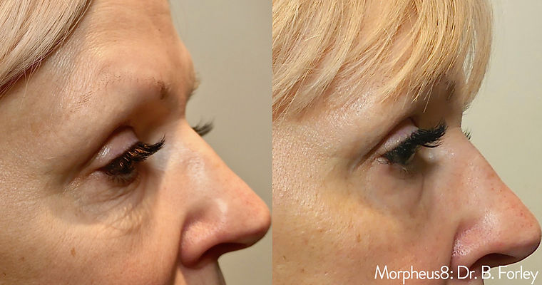 Morpheus face result before and after picture in Las Vegas
