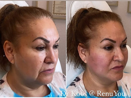 Dr. Stephanie Koos RenuYou PDO thread lift before/after
