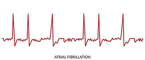 ecg-heartbeat-line-electrocardiogram-illustration-atrial-fibrillation-vector.jpg
