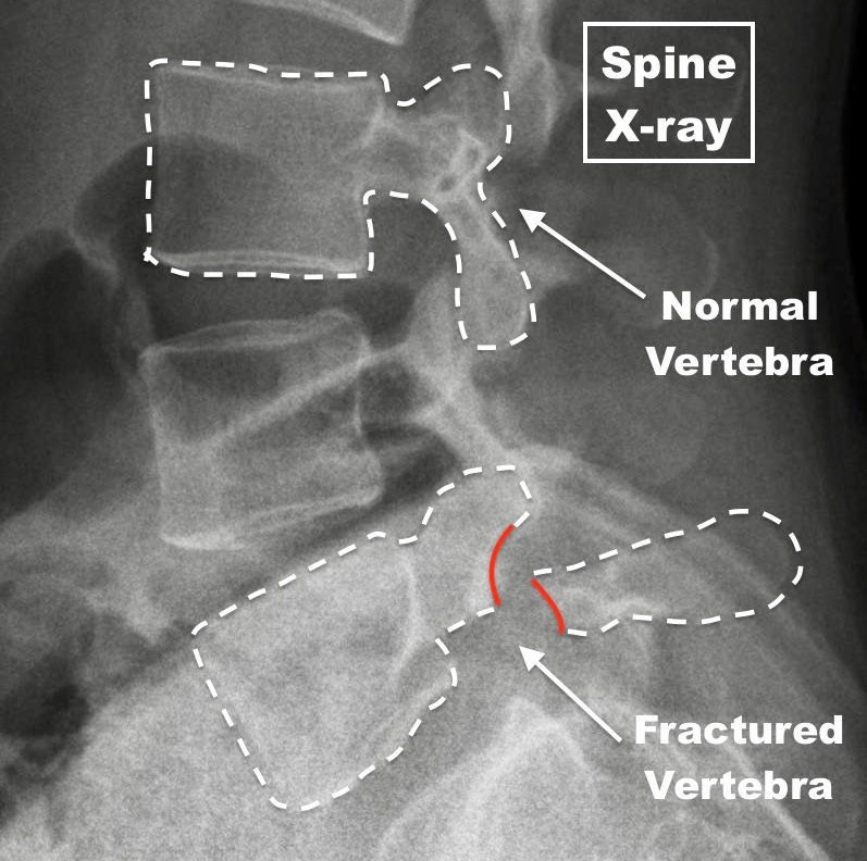 Stress Fracture of the Spine (Spondylolysis)