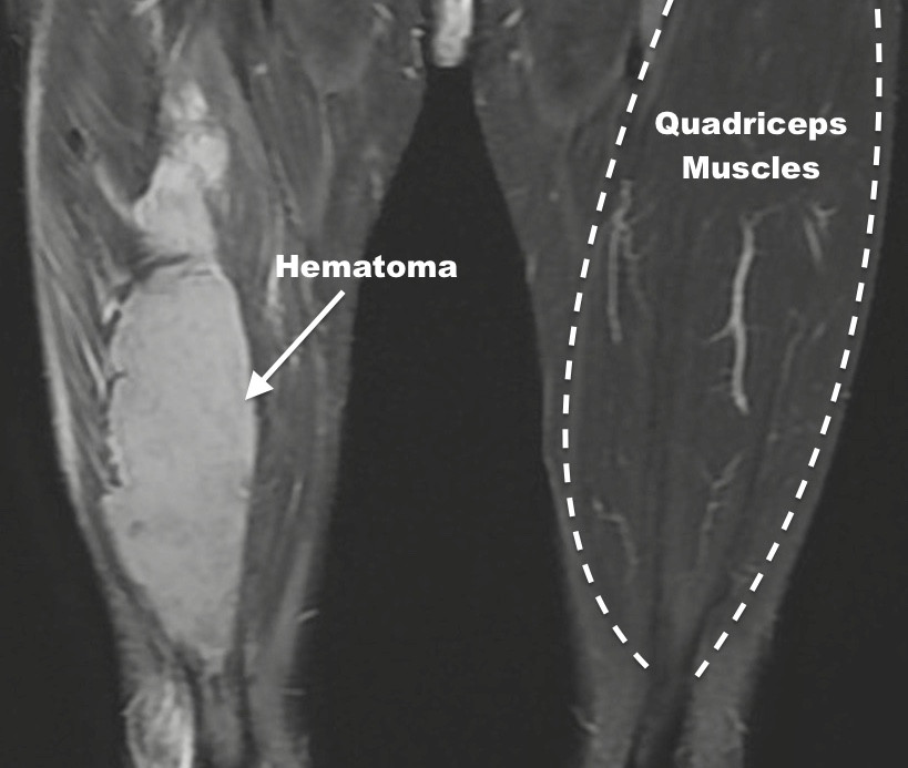 Quadriceps Hematoma