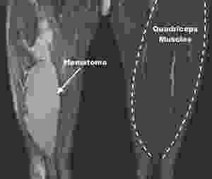 Quadriceps Hematoma