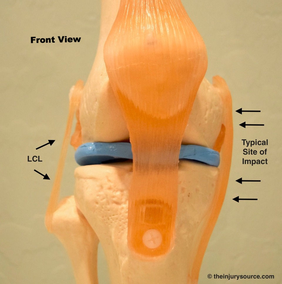 Isolated LCL (Lateral Collateral Ligament) Injury