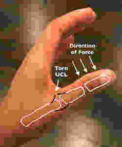 Ulnar Collateral Ligament Injury