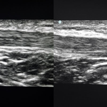 Case # 2 - Knee Pain in a Sprinter