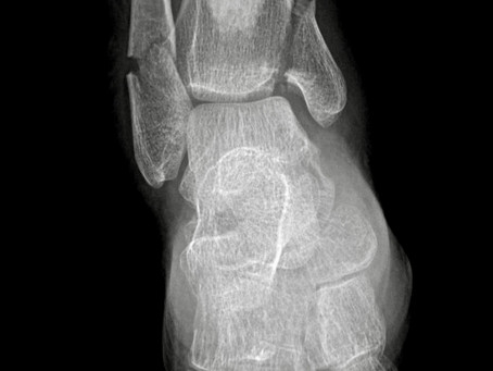 Dak Prescott - Ankle Dislocation & Fracture