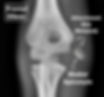 Rotated Medial Epicondyle Fracture