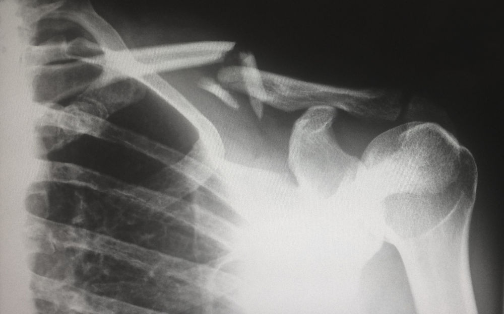 Clavicle Fracture (Collar Bone)