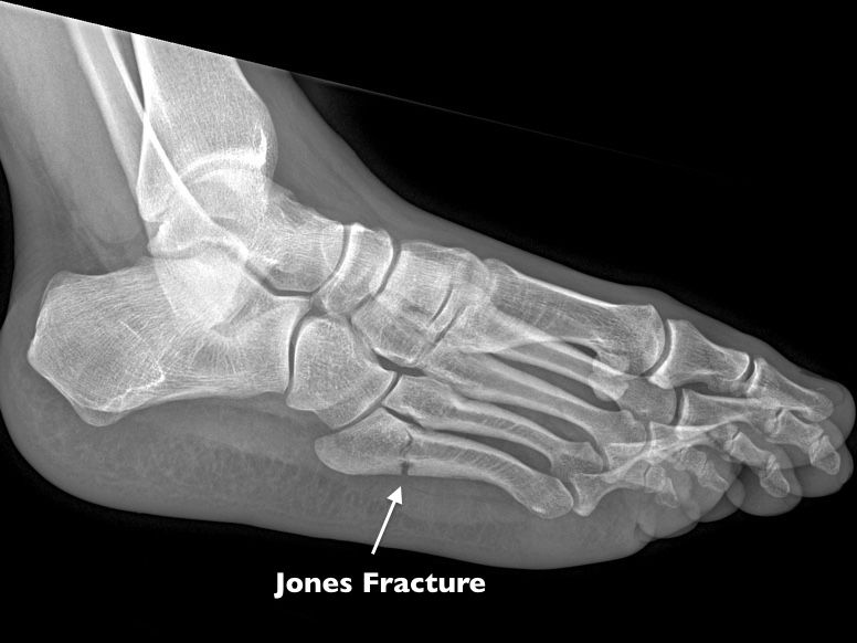 What Exactly is a Jones Fracture (Foot) and Why Might it Need Surgery?