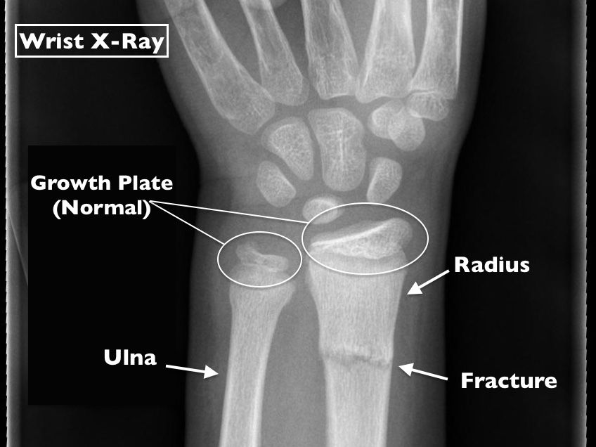 What Makes a Pediatric Wrist Fracture Different?