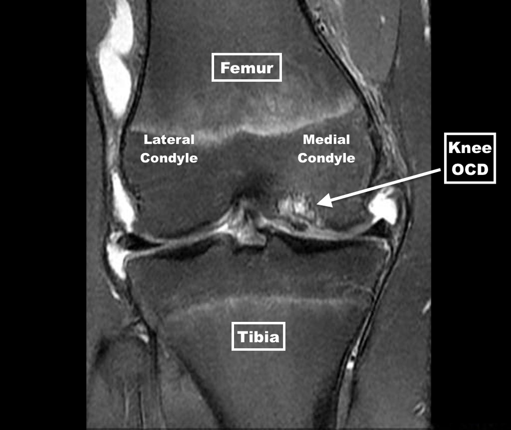Osteochondritis Dissecans of the Knee