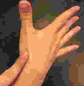 Anatomical Snuffbox Tenderness with a Scaphoid Fracture