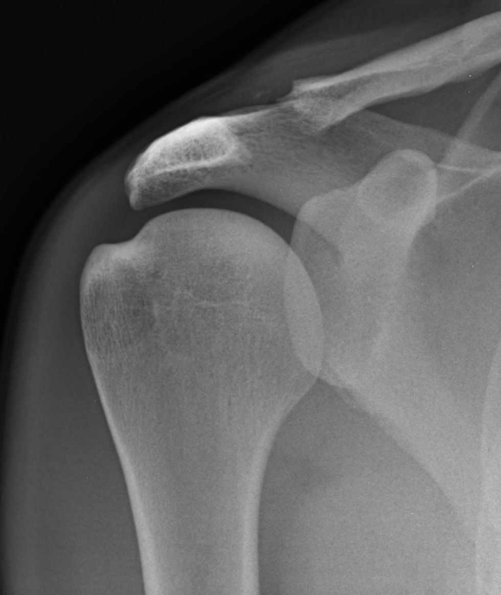 Distal Clavicular Osteolysis