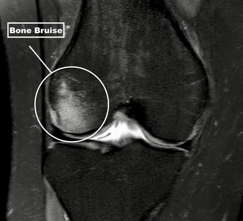 what-exactly-is-a-bone-bruise