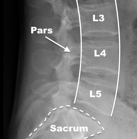 Stress Fracture of the Spine (Spondylolysis)