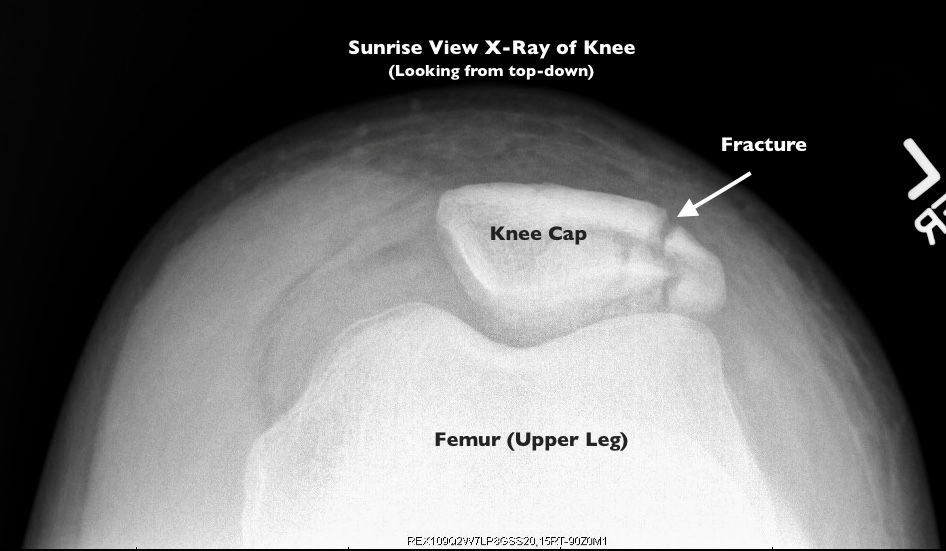Patella (Knee Cap) Fracture