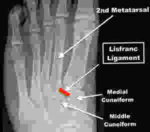 Lisfranc Ligament