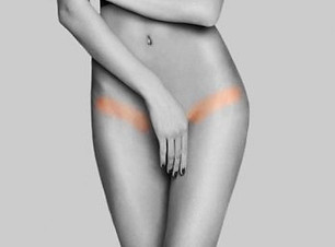 íntim szőrtelenítés