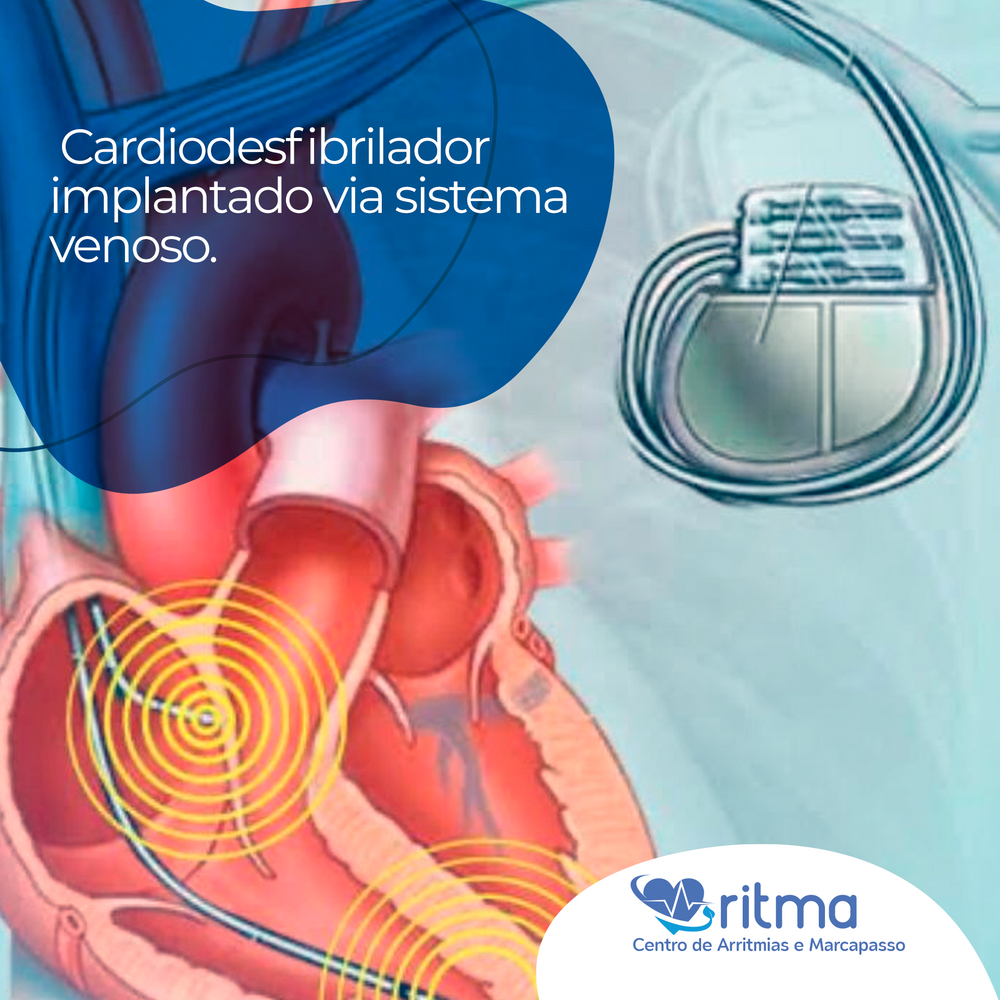 O Nodo Sinoatrial E Normalmente O Marcapasso Cardiaco Porque