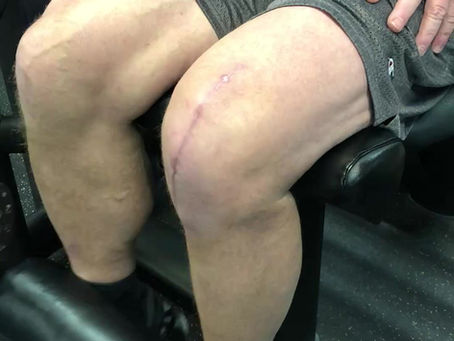 “Not Your Dad’s Hip Replacement: Modern Joint Surgery and Recovery Explained”