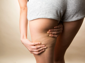 COME ELIMINARE LA CELLULITE 