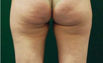 Cellulitetherapie AWT Storz Stoßwelle Reutlingen