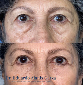 Antes y despues 5