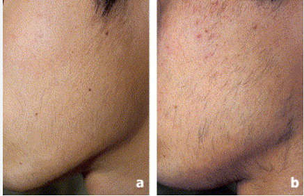 Thumbnail: Natural Hair Removal - Hirsutism