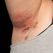 Hidradenitis Suppurativa Ointment