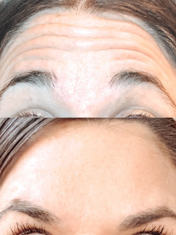 Heather Botox .jpg